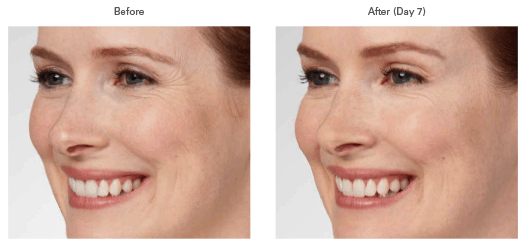 A woman 's face before and after botox.