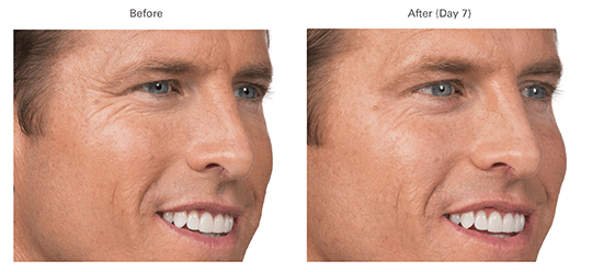 A man 's face before and after botox treatment.