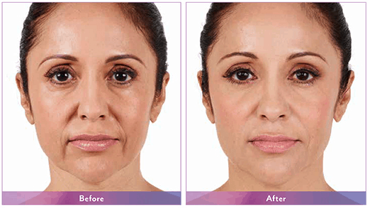 A woman before and after botox treatment.