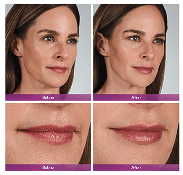 A woman before and after using juvederm.