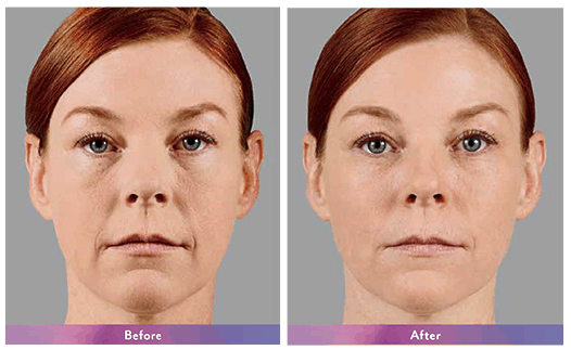 A woman before and after undergoing botox.