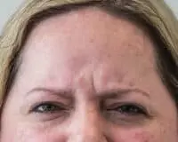 A woman with wrinkles on her forehead and eyes.