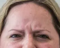 A woman with wrinkles on her forehead and eyes.