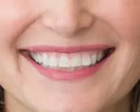 A close up of a person 's smile with teeth.