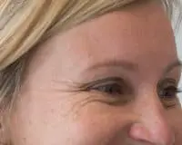 A woman with wrinkles on her face and eyes.