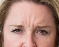 A woman with wrinkles on her forehead and eyes.