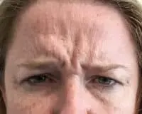 A woman with wrinkles on her forehead and face.