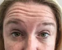 A woman with wrinkles on her forehead and eyes.