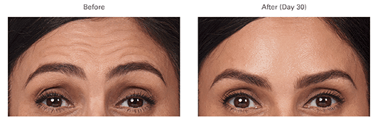 botox before and after 3