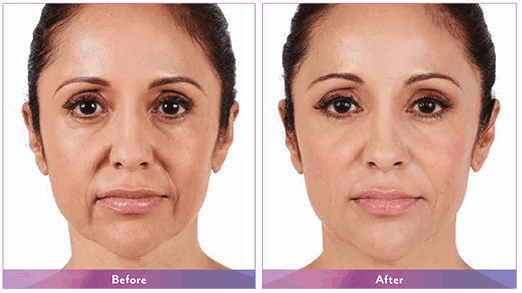 juvederm xc before and after juvederm xc before and after