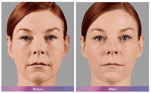 voluma before and after voluma before and after